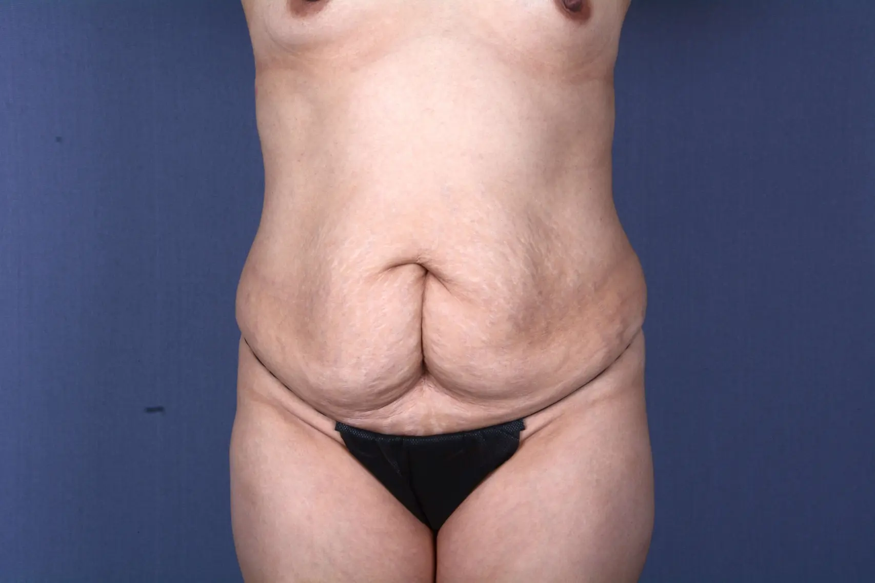 liposuction Las Vegas NV