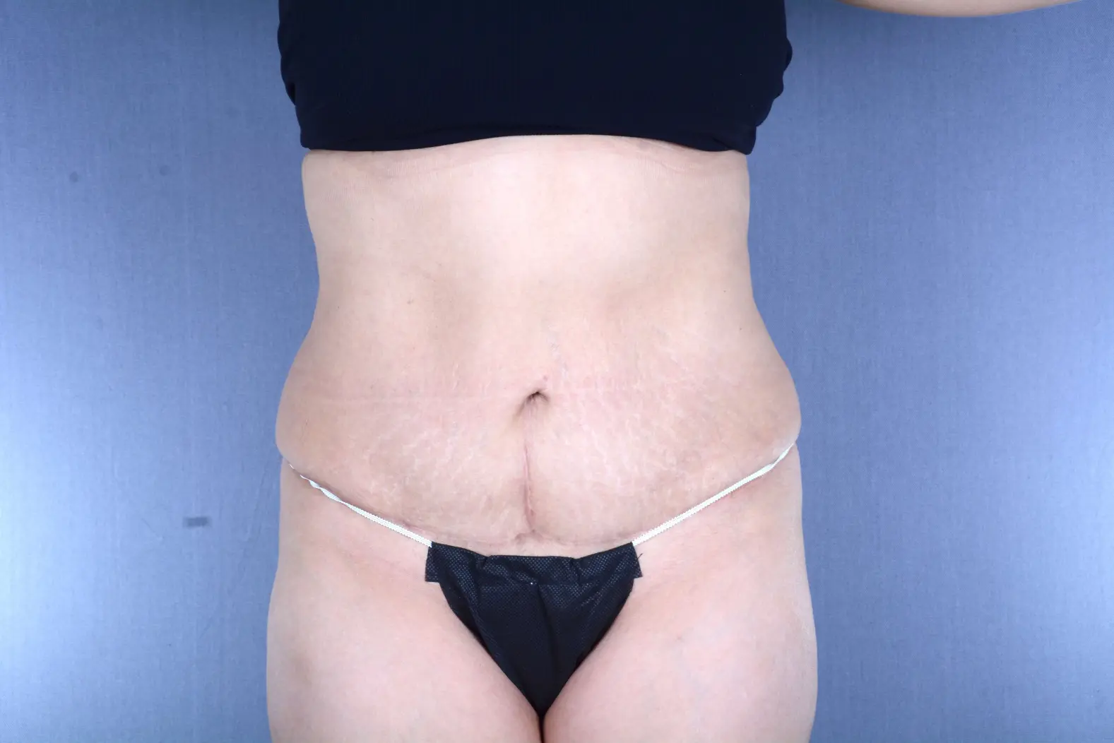 Brazilian butt lift with liposuction Las Vegas NV