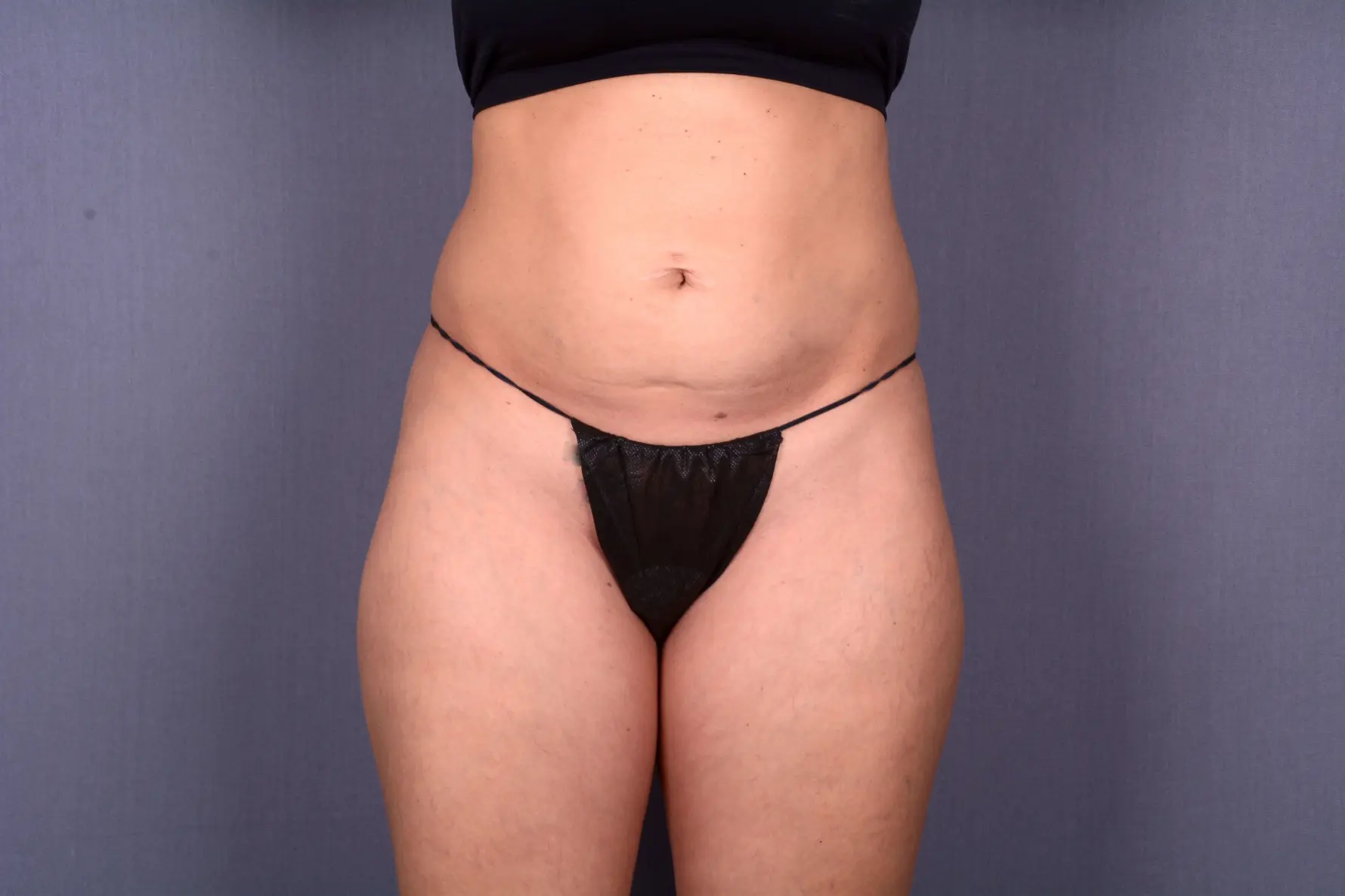 Brazilian butt lift with liposuction Las Vegas NV