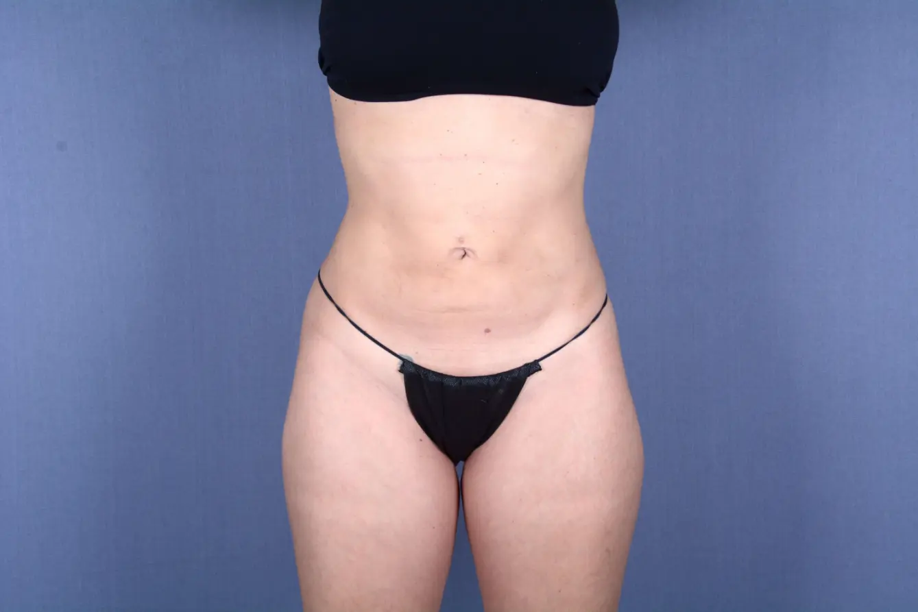 tummy tuck Las Vegas NV